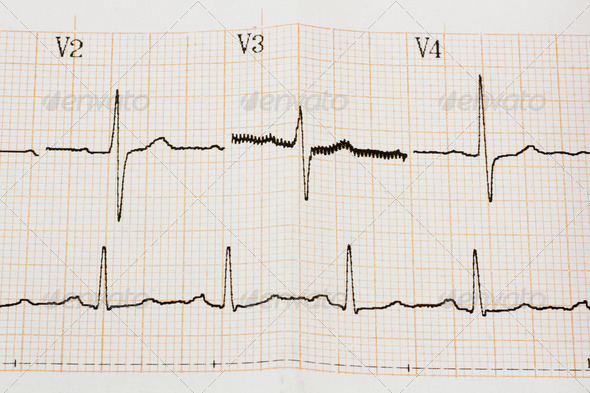 Arrhythmia (Misc) Photo Download